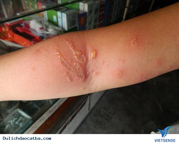 Làm Gì Khi Đi Biển Bị Sứa Đốt - Ảnh 2